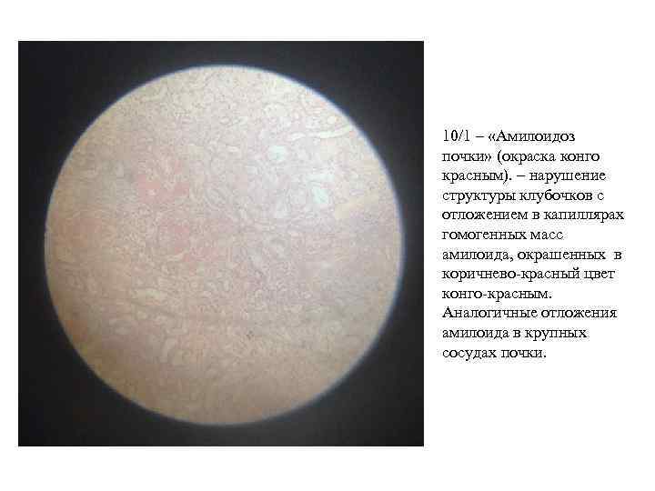 10/1 – «Амилоидоз почки» (окраска конго красным). – нарушение структуры клубочков с отложением в