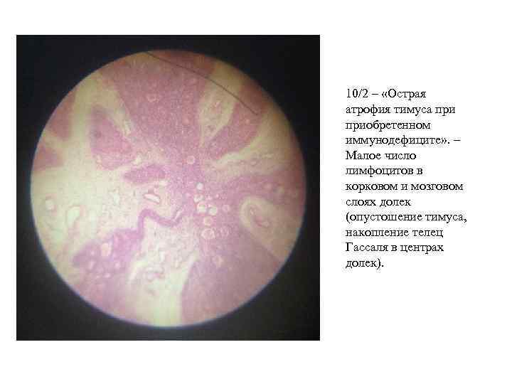 10/2 – «Острая атрофия тимуса приобретенном иммунодефиците» . – Малое число лимфоцитов в корковом