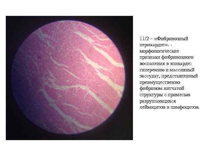 11/2 – «Фибринозный перикардит» . - морфологические признаки фибринозного воспаления в эпикарде: гиперемию и