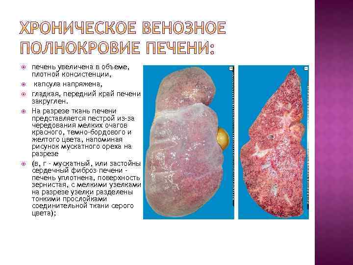  печень увеличена в объеме, плотной консистенции, капсула напряжена, гладкая, передний край печени закруглен.