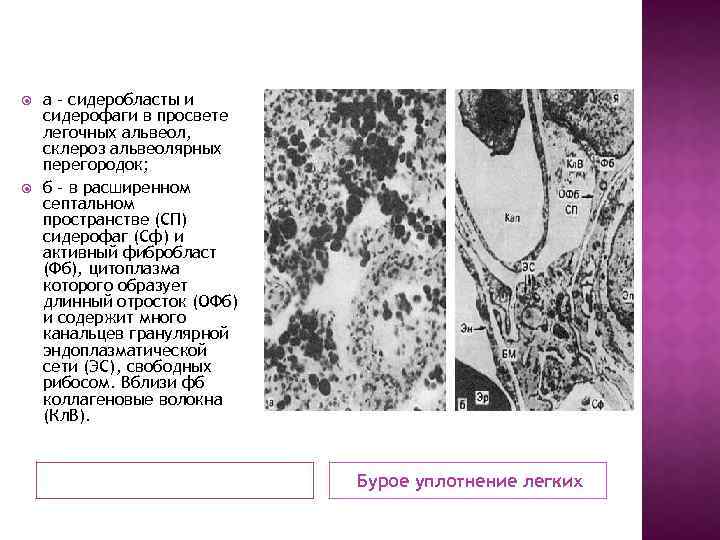  а - сидеробласты и сидерофаги в просвете легочных альвеол, склероз альвеолярных перегородок; б