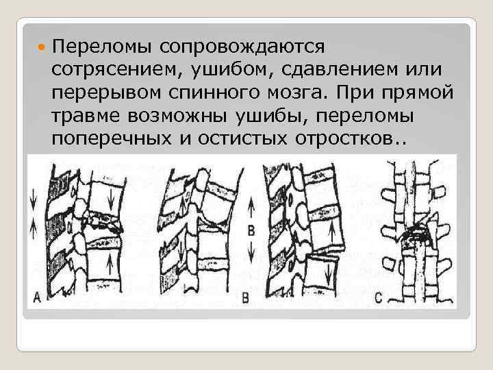  Переломы сопровождаются сотрясением, ушибом, сдавлением или перерывом спинного мозга. При прямой травме возможны