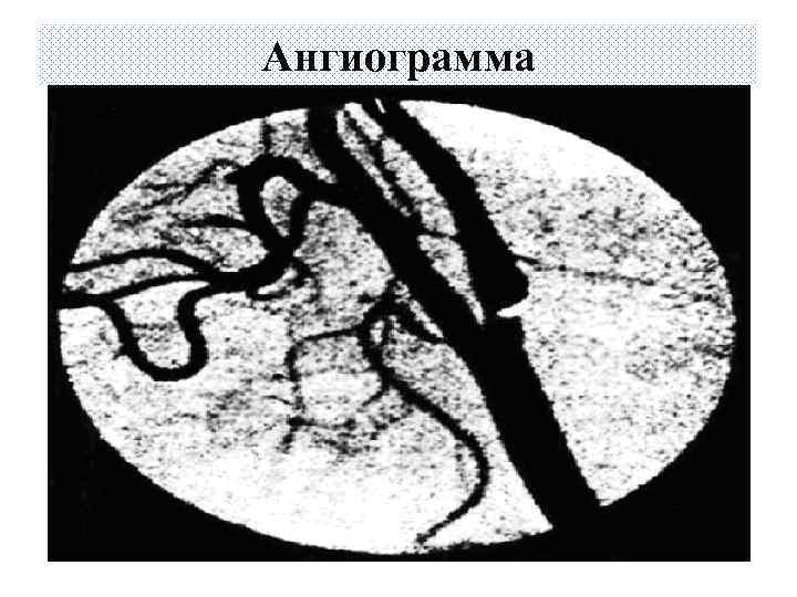 Ангиограмма 