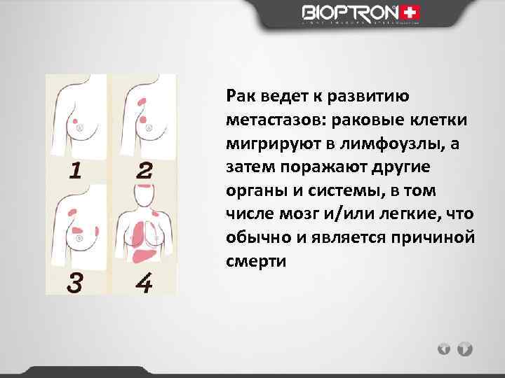 Рак ведет к развитию метастазов: раковые клетки мигрируют в лимфоузлы, а затем поражают другие