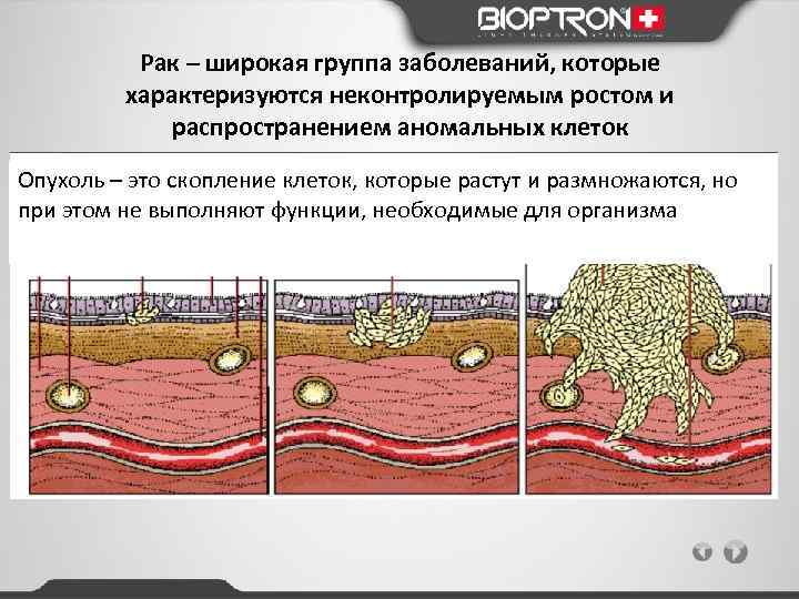 Рак – широкая группа заболеваний, которые характеризуются неконтролируемым ростом и распространением аномальных клеток Опухоль