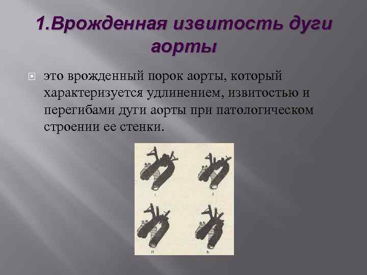 1. Врожденная извитость дуги аорты это врожденный порок аорты, который характеризуется удлинением, извитостью и