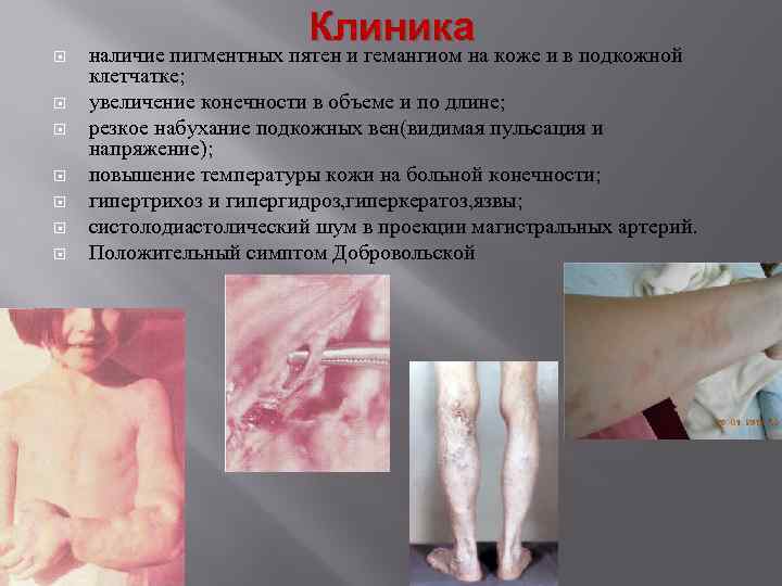  Клиника наличие пигментных пятен и гемангиом на коже и в подкожной клетчатке; увеличение