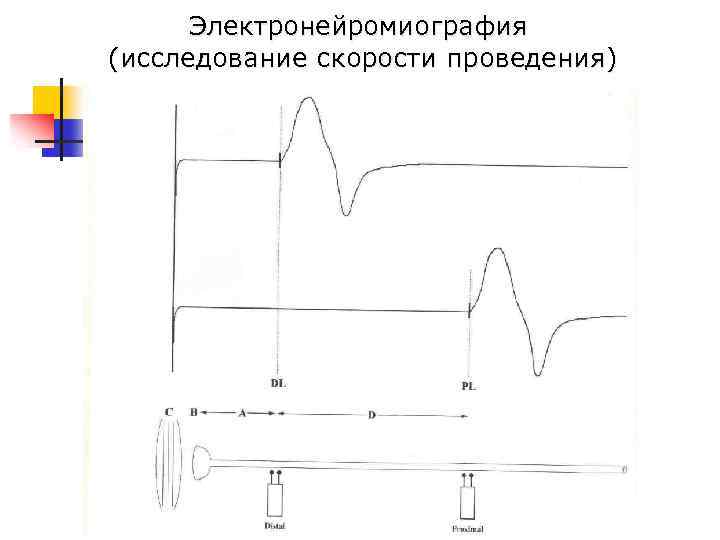 Электронейромиография (исследование скорости проведения) 