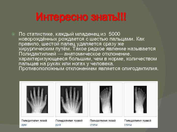 Интересно знать!!! По статистике, каждый младенец из 5000 новорождённых рождается с шестью пальцами. Как