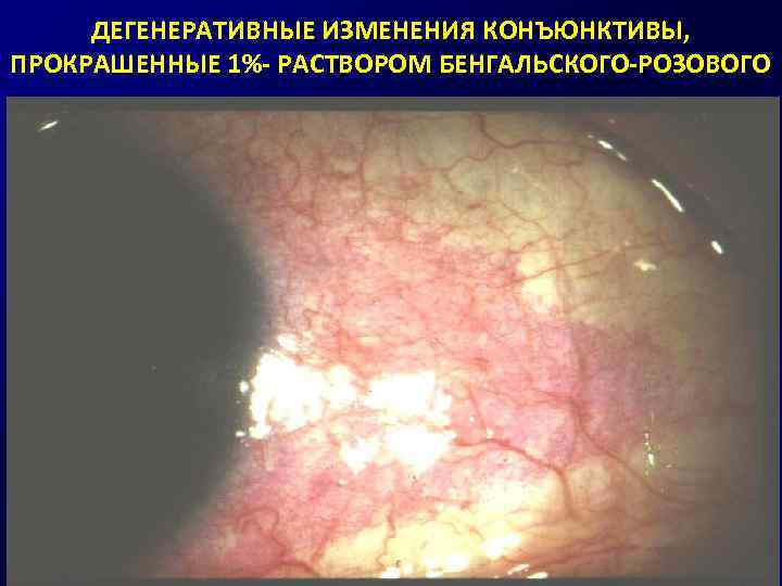 ДЕГЕНЕРАТИВНЫЕ ИЗМЕНЕНИЯ КОНЪЮНКТИВЫ, ПРОКРАШЕННЫЕ 1%- РАСТВОРОМ БЕНГАЛЬСКОГО-РОЗОВОГО 