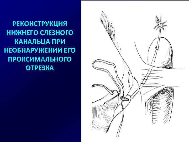 РЕКОНСТРУКЦИЯ НИЖНЕГО СЛЕЗНОГО КАНАЛЬЦА ПРИ НЕОБНАРУЖЕНИИ ЕГО ПРОКСИМАЛЬНОГО ОТРЕЗКА 