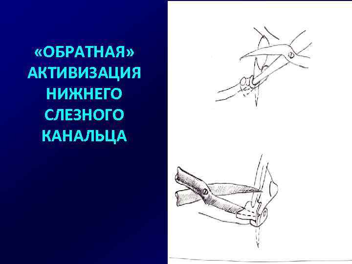  «ОБРАТНАЯ» АКТИВИЗАЦИЯ НИЖНЕГО СЛЕЗНОГО КАНАЛЬЦА 