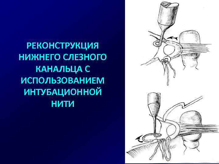 РЕКОНСТРУКЦИЯ НИЖНЕГО СЛЕЗНОГО КАНАЛЬЦА С ИСПОЛЬЗОВАНИЕМ ИНТУБАЦИОННОЙ НИТИ 