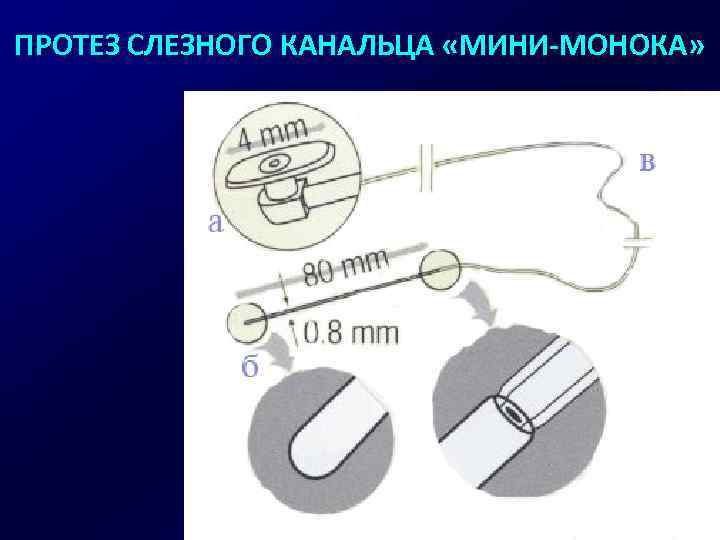 ПРОТЕЗ СЛЕЗНОГО КАНАЛЬЦА «МИНИ-МОНОКА» 