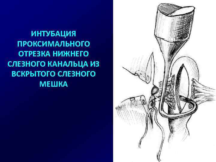 ИНТУБАЦИЯ ПРОКСИМАЛЬНОГО ОТРЕЗКА НИЖНЕГО СЛЕЗНОГО КАНАЛЬЦА ИЗ ВСКРЫТОГО СЛЕЗНОГО МЕШКА 