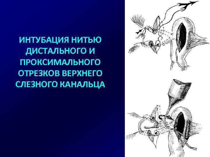 ИНТУБАЦИЯ НИТЬЮ ДИСТАЛЬНОГО И ПРОКСИМАЛЬНОГО ОТРЕЗКОВ ВЕРХНЕГО СЛЕЗНОГО КАНАЛЬЦА 