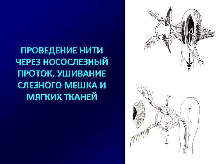 ПРОВЕДЕНИЕ НИТИ ЧЕРЕЗ НОСОСЛЕЗНЫЙ ПРОТОК, УШИВАНИЕ СЛЕЗНОГО МЕШКА И МЯГКИХ ТКАНЕЙ 