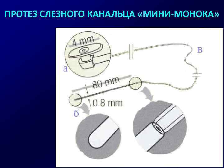 ПРОТЕЗ СЛЕЗНОГО КАНАЛЬЦА «МИНИ-МОНОКА» 