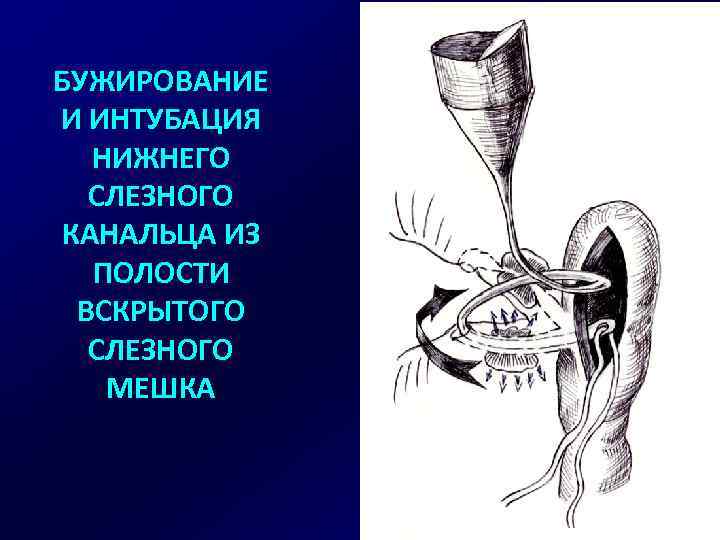 БУЖИРОВАНИЕ И ИНТУБАЦИЯ НИЖНЕГО СЛЕЗНОГО КАНАЛЬЦА ИЗ ПОЛОСТИ ВСКРЫТОГО СЛЕЗНОГО МЕШКА 