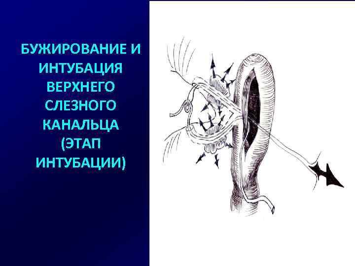 БУЖИРОВАНИЕ И ИНТУБАЦИЯ ВЕРХНЕГО СЛЕЗНОГО КАНАЛЬЦА (ЭТАП ИНТУБАЦИИ) 