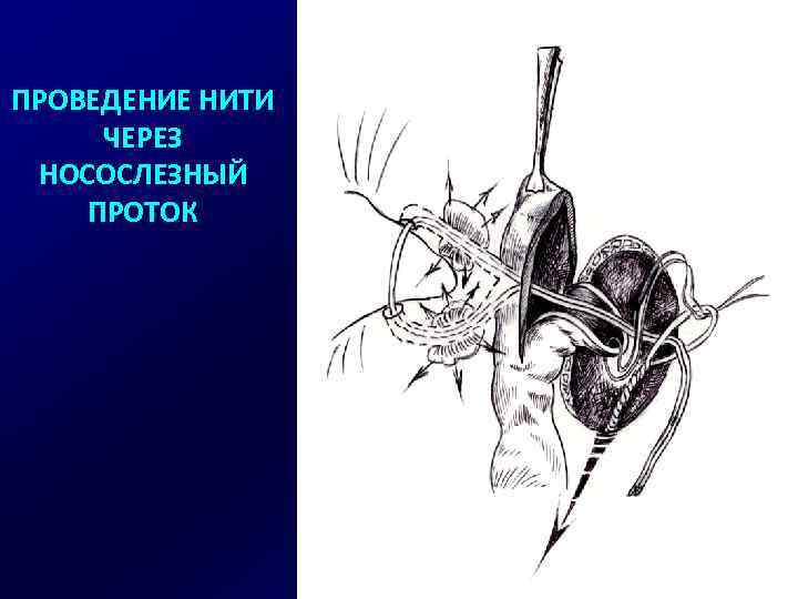 ПРОВЕДЕНИЕ НИТИ ЧЕРЕЗ НОСОСЛЕЗНЫЙ ПРОТОК 