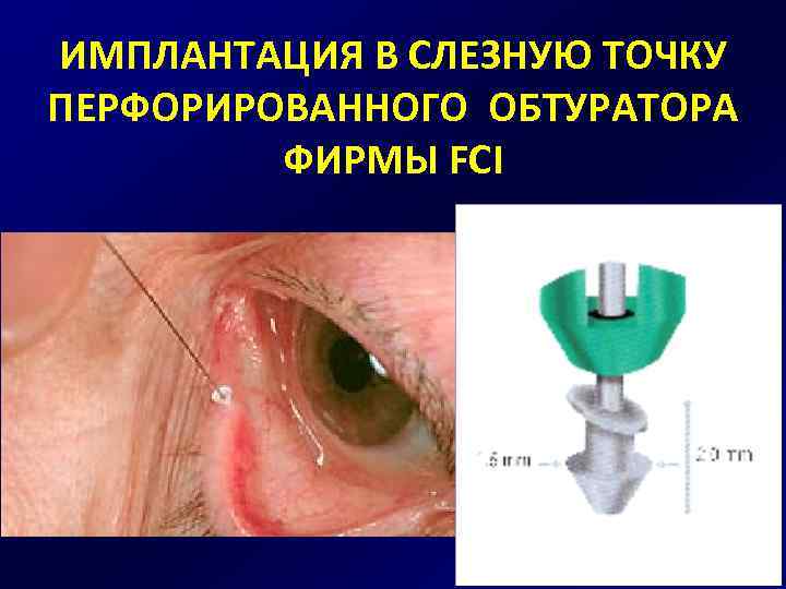 ИМПЛАНТАЦИЯ В СЛЕЗНУЮ ТОЧКУ ПЕРФОРИРОВАННОГО ОБТУРАТОРА ФИРМЫ FCI 