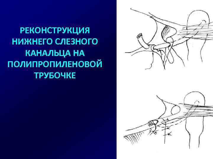 РЕКОНСТРУКЦИЯ НИЖНЕГО СЛЕЗНОГО КАНАЛЬЦА НА ПОЛИПРОПИЛЕНОВОЙ ТРУБОЧКЕ 