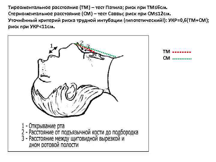 Тиреоментальное расстояние (ТМ) – тест Патила; риск при ТМ≤ 6 см. Стерноментальное расстояние (СМ)