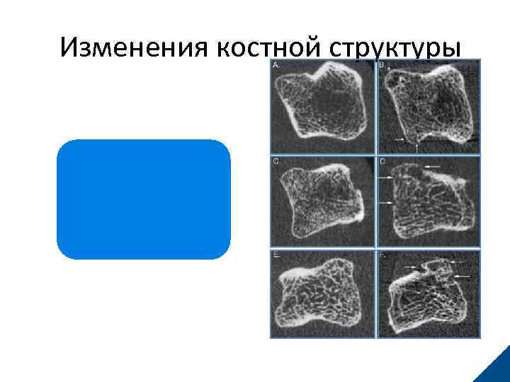 Изменения костной структуры 