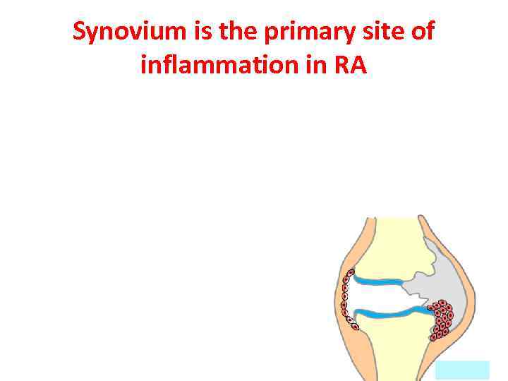 Synovium is the primary site of inflammation in RA 