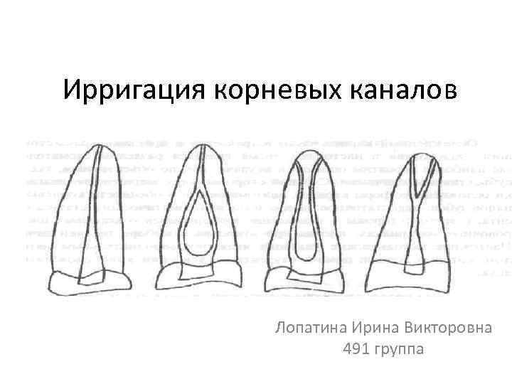 Ирригация корневых каналов презентация