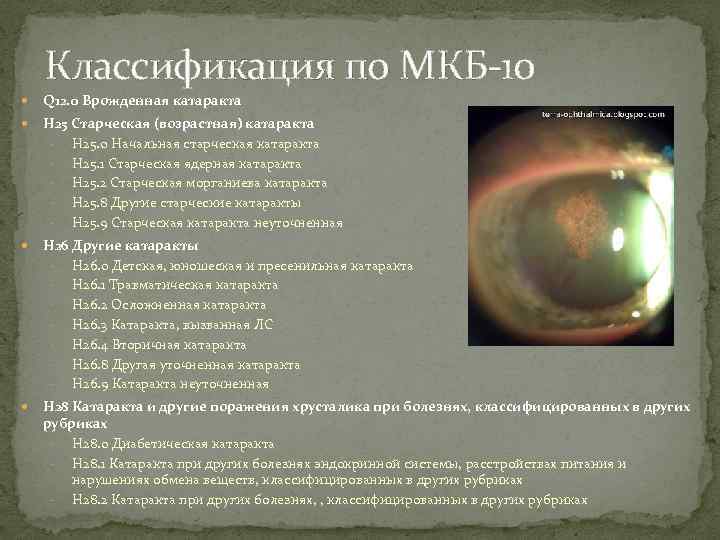 Классификация по МКБ-10 Q 12. 0 Врожденная катаракта H 25 Старческая (возрастная) катаракта -