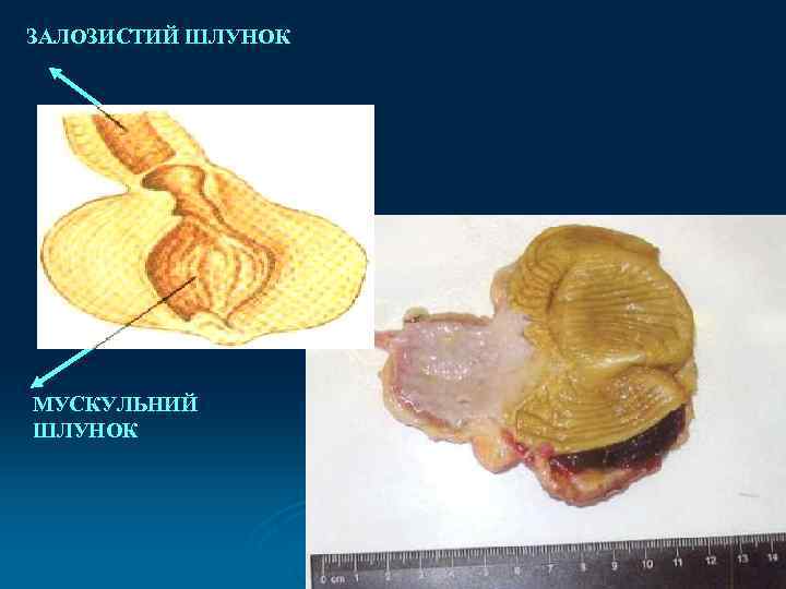 ЗАЛОЗИСТИЙ ШЛУНОК МУСКУЛЬНИЙ ШЛУНОК 