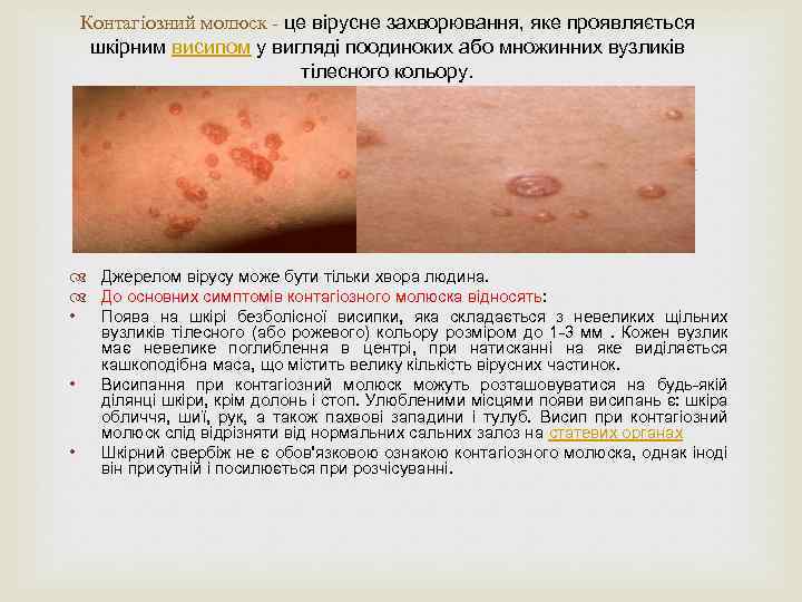 Контагіозний молюск - це вірусне захворювання, яке проявляється шкірним висипом у вигляді поодиноких або