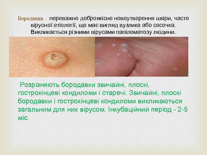 Бородавка - переважно доброякісне новоутворення шкіри, часто вірусної етіології, що має вигляд вузлика або
