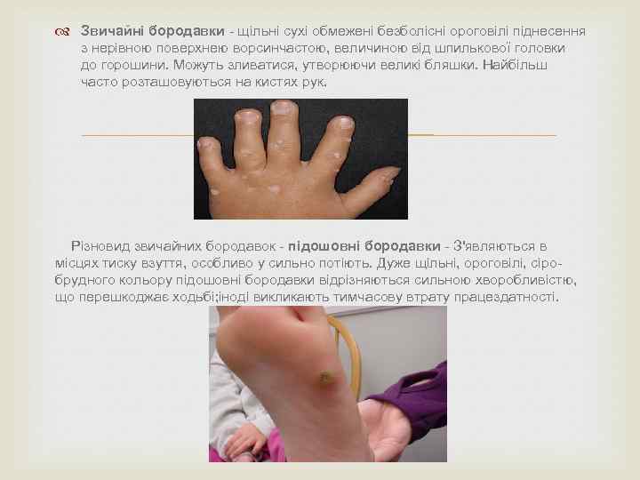  Звичайні бородавки - щільні сухі обмежені безболісні ороговілі піднесення з нерівною поверхнею ворсинчастою,