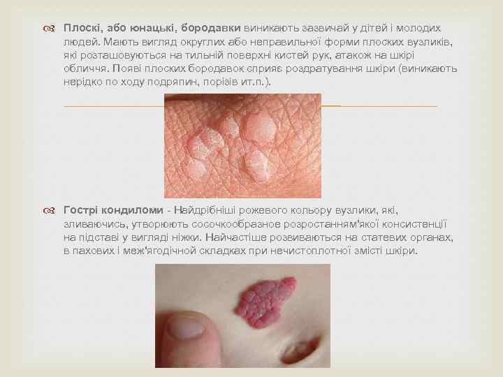  Плоскі, або юнацькі, бородавки виникають зазвичай у дітей і молодих людей. Мають вигляд