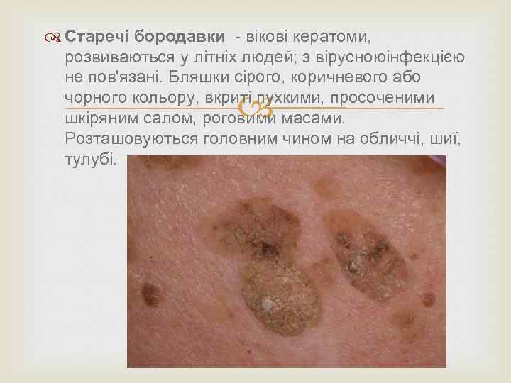 Старечі бородавки - вікові кератоми, розвиваються у літніх людей; з вірусноюінфекцією не пов'язані.