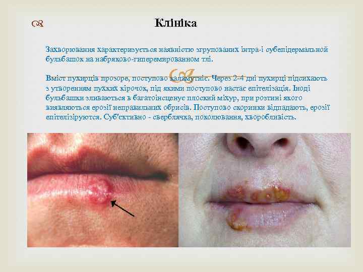  Клініка Захворювання характеризується наявністю згрупованих інтра-і субепідермальной бульбашок на набряково-гиперемированном тлі. Вміст пухирців