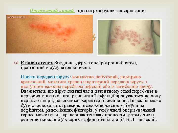Оперізуючий лишай - це гостре вірусне захворювання. Етіопатогенез. Збудник - дерматонейротропний вірус, ідентичний вірусу