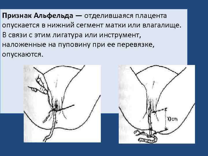 Признак Альфельда — отделившаяся плацента опускается в нижний сегмент матки или влагалище. В связи