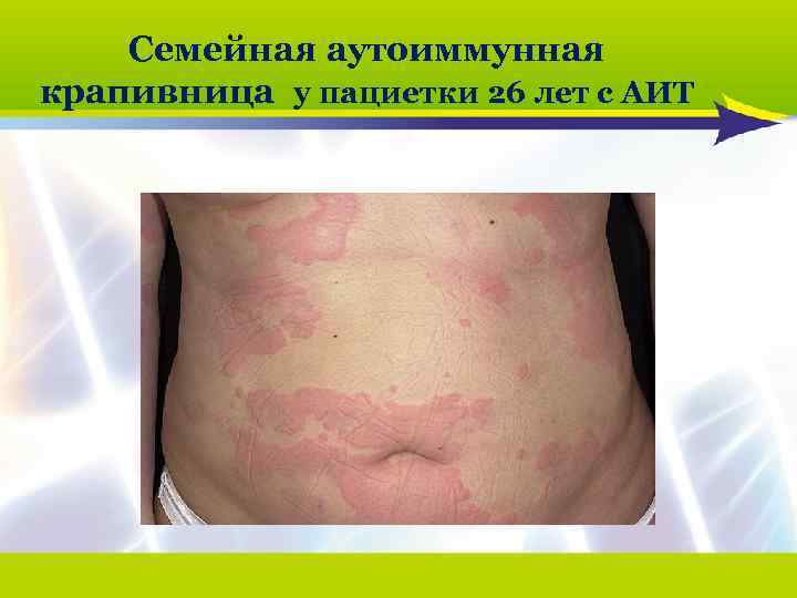 Семейная аутоиммунная крапивница у пациетки 26 лет с АИТ 