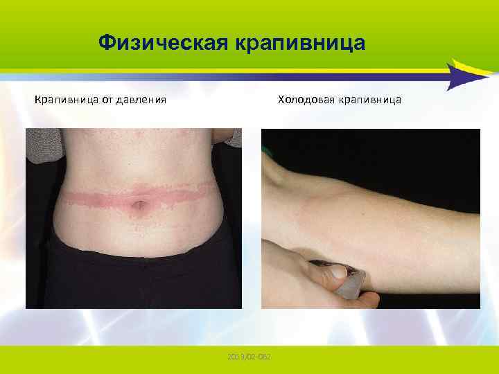 Физическая крапивница Крапивница от давления Холодовая крапивница 2013/02 -062 