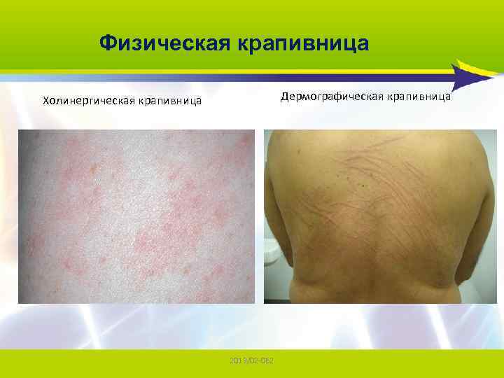 Физическая крапивница Дермографическая крапивница Холинергическая крапивница 2013/02 -062 