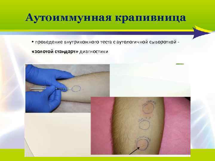 Аутоиммунная крапивница • проведение внутрикожного теста с аутологичной сывороткой - «золотой стандарт» диагностики 2013/02