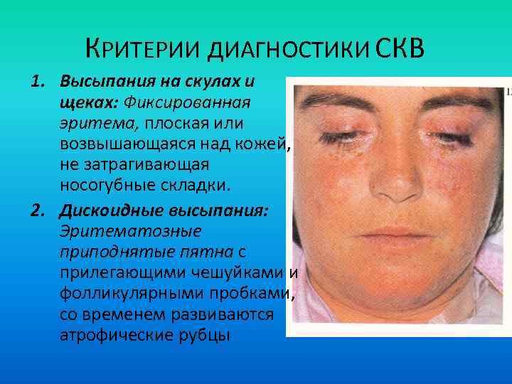 КРИТЕРИИ ДИАГНОСТИКИ СКВ 1. Высыпания на скулах и щеках: Фиксированная эритема, плоская или возвышающаяся