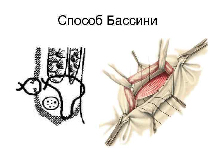 Бассини при бедренной грыже