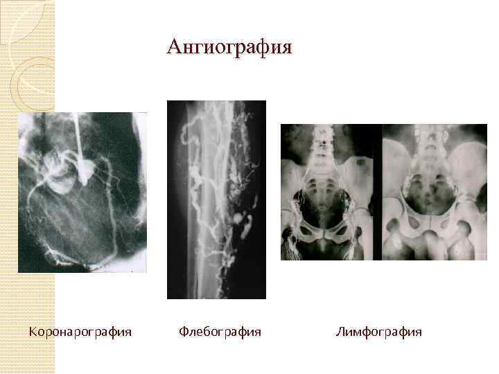 Ангиография Коронарография Флебография Лимфография 