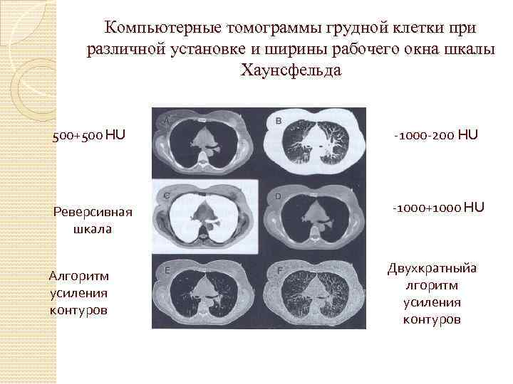 Компьютерные томограммы грудной клетки при различной установке и ширины рабочего окна шкалы Хаунсфельда -500+500