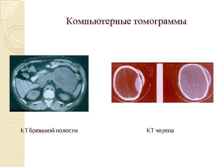 Компьютерные томограммы КТ брюшной полости КТ черепа 